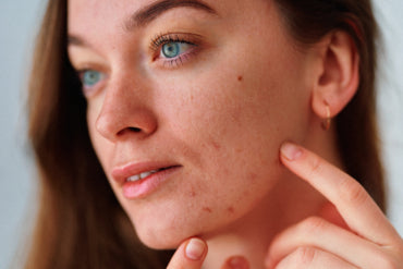 How Balance Helps Adults Treat Hormonal Acne